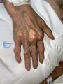 Goutte et tophus39.jpg