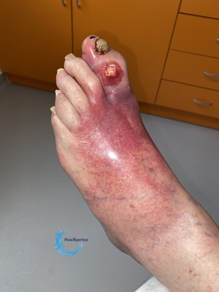 Fichier:Pied infecté18.jpg