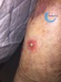 Pustules14.jpg