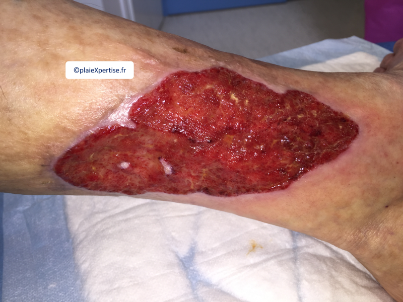 Fichier:Tissu de granulation inflammatoire4.png