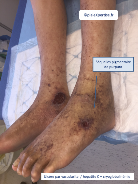Fichier:Vascularite5.png