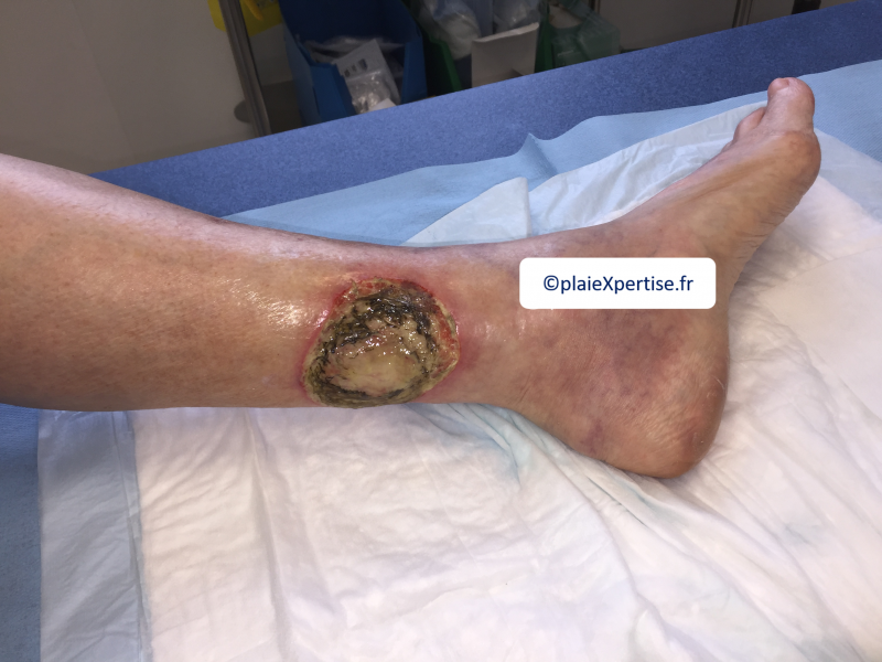 Fichier:Angiodermite typique19.png
