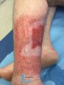 Epidermisation7.jpg
