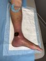 Pyoderma gangrenosum25.jpg