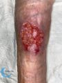 Epidermisation13.jpg