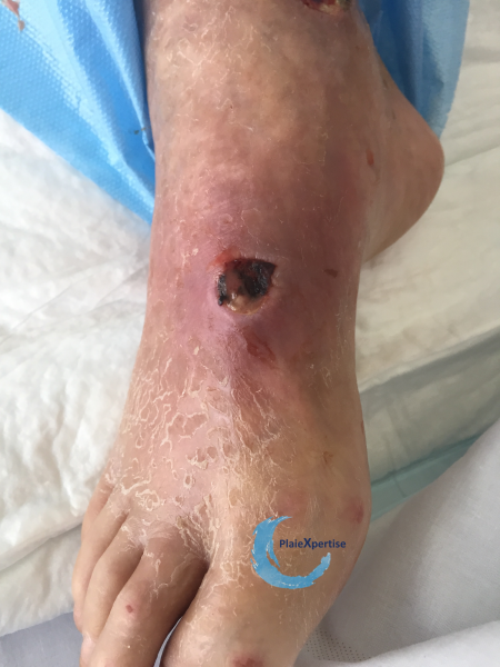 Fichier:Cou de pied54.png