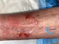 Pustules17.jpg