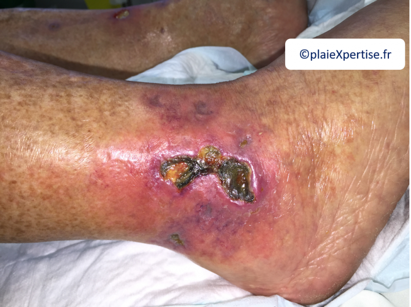 Fichier:Angiodermite typique6.png