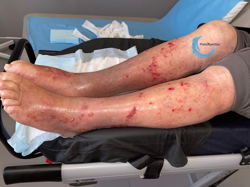 Fichier:Eczéma craquelé35.jpg