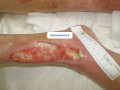 Tendon-Reliquat1.png