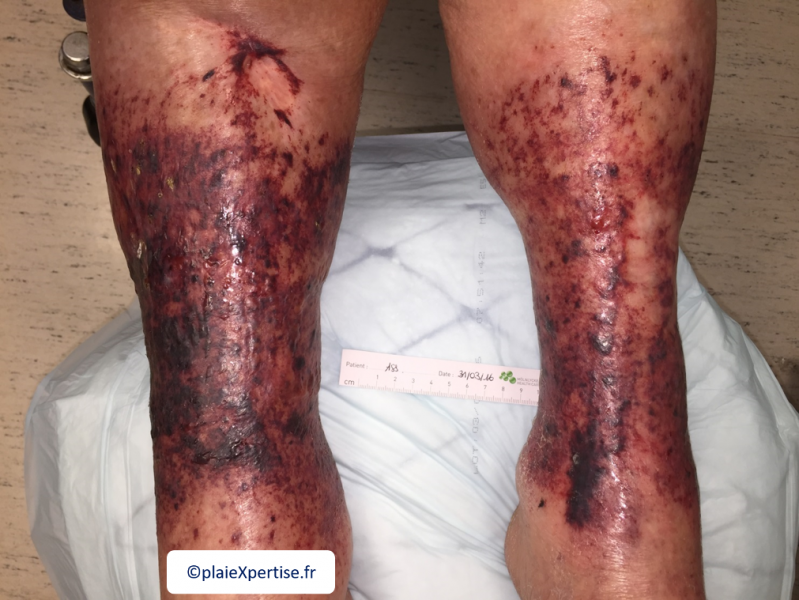Fichier:Purpura par fragilité capillaire1.png