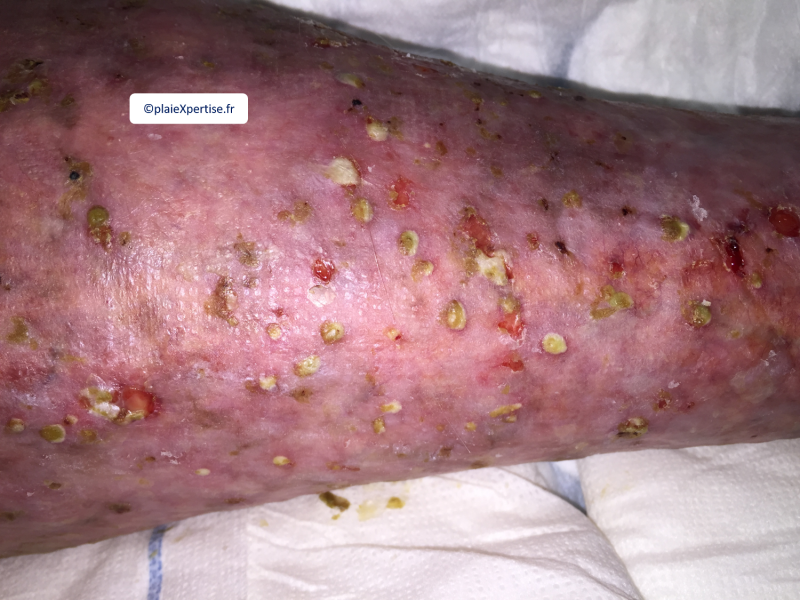 Fichier:Pustules7.png