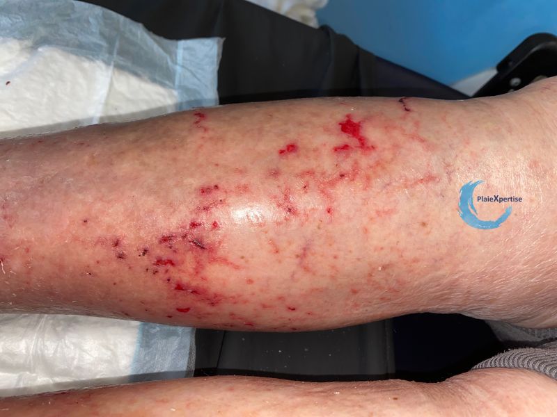 Fichier:Eczéma craquelé36.jpg