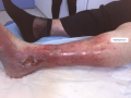 Erosion ponctiforme moins de 5 mm5.png