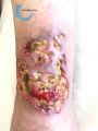 Pyoderma gangrenosum27.jpg