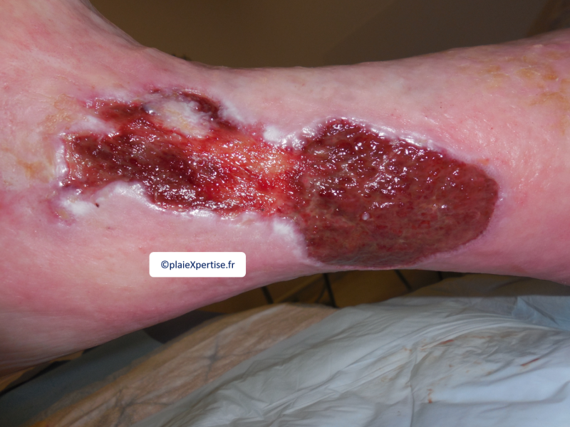 Fichier:Tissu de granulation inflammatoire2.png