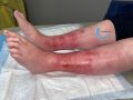 Dermite d'irritation150.jpg