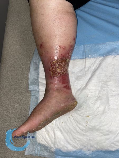 Fichier:Pyoderma gangrenosum58.jpg
