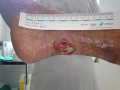 Tendon-Reliquat6.png