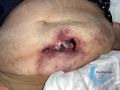 Calciphylaxie8.jpg