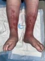 Dermite d'irritation151.jpg