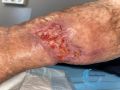 Epidermisation16.jpg