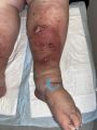 Hypodermite chronique73.jpg