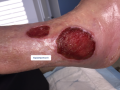 Tissu de granulation inflammatoire3.png