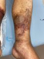 Dermiteocre90.jpg