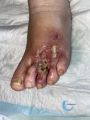 Pied infecté32.jpg