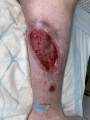 Tissu de granulation inflammatoire36.png