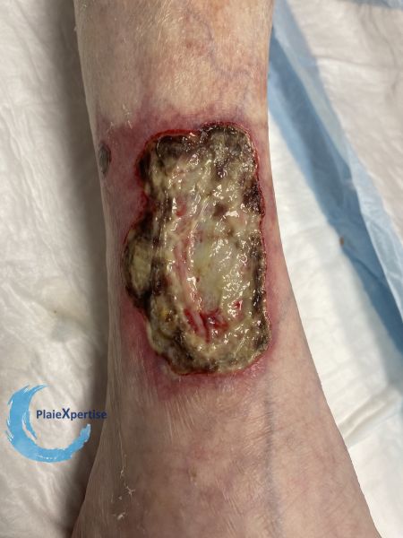 Fichier:Angiodermite typique91.jpg