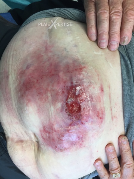 Fichier:Dermite d'irritation17.jpg