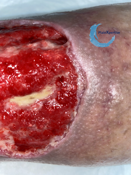 Fichier:Tissu de granulation normal34.png