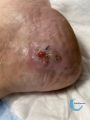 Calcifications41.jpg