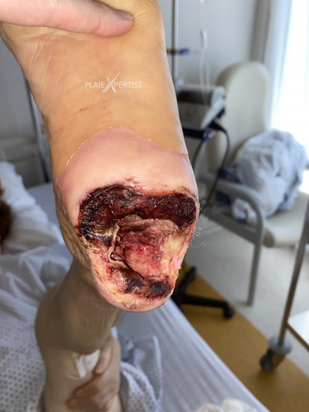 Fichier:Escarre5.png