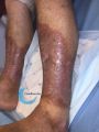 Nécrobiose lipoïdique18.jpg
