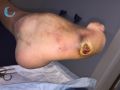 Pied de Charcot15.jpg