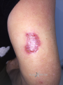 Pyoderma gangrenosum15.png