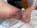 Pyoderma gangrenosum46.jpg
