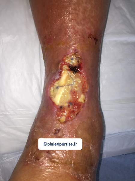 Fichier:Tendon nécrotique humide37.png