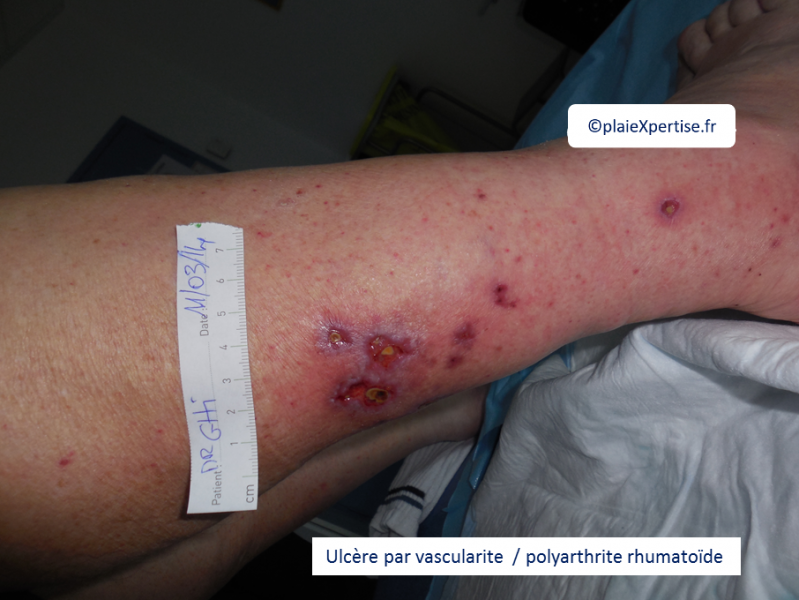 Fichier:Vascularite3.png