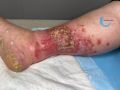 Dermite d'irritation155.jpg