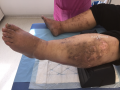 Grosses jambes suintantes25.png