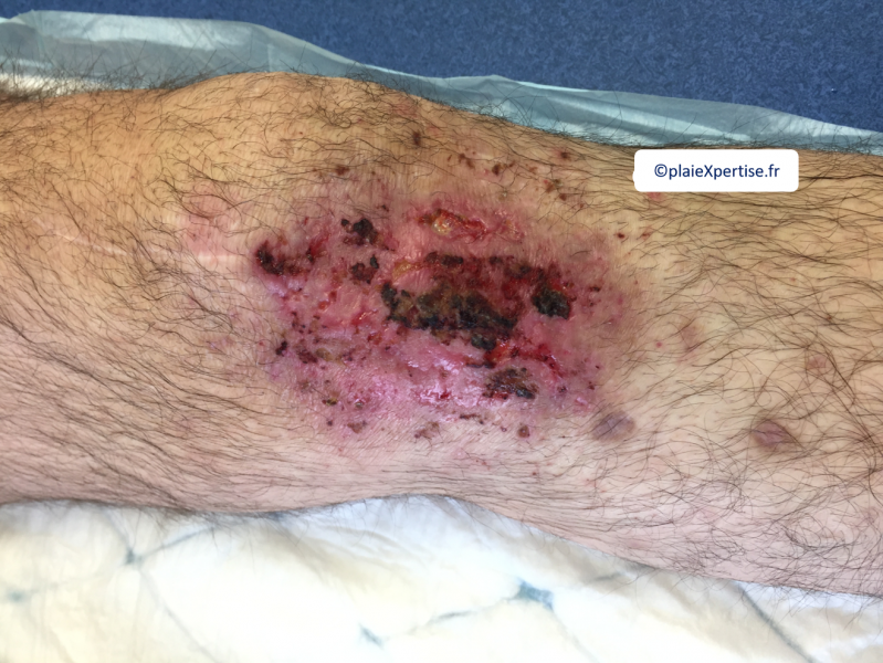 Fichier:Pyoderma gangrenosum2.png