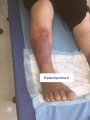 Dermiteocre25.png