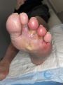 Pied infecté3.jpg