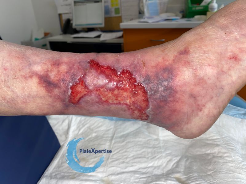 Fichier:Angiodermite typique100.jpg