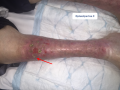 Pustules6.png