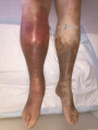 Dermiteocre37.png